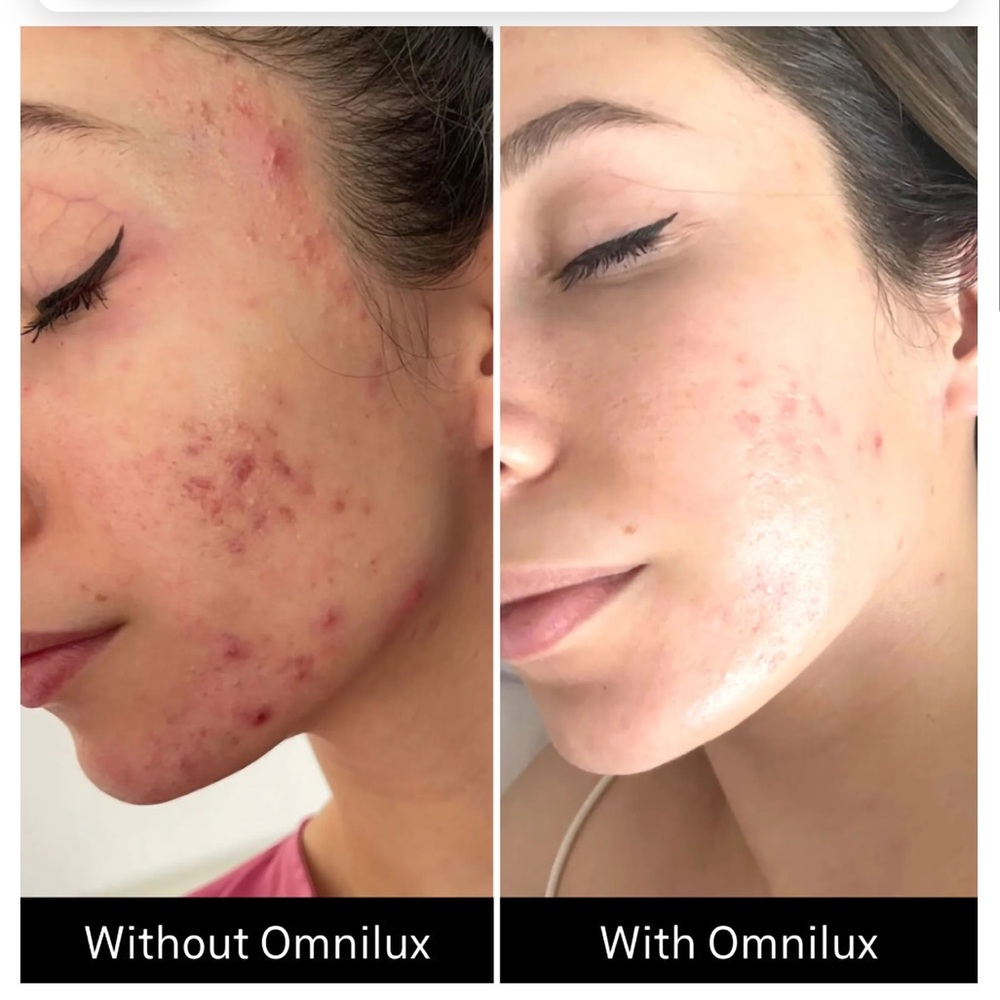 OMNILUX Clear Skin LED Mask - Picture 5 of 6
